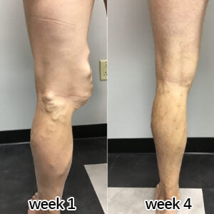 Customer knee comparison